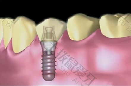 全口牙齿种植价格