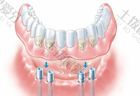 满口种植牙需要注意什么