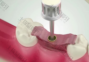 种植义齿多久取模 种植牙二期修复取模的步骤
