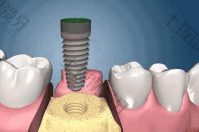 种植牙二期手术怎么做 种植牙二期取模拧螺丝很痛怎么办