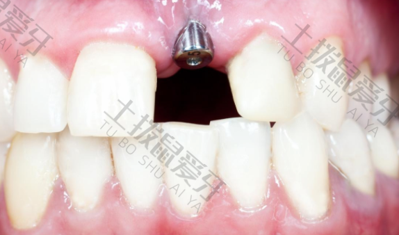 半口牙种植能使用多久 