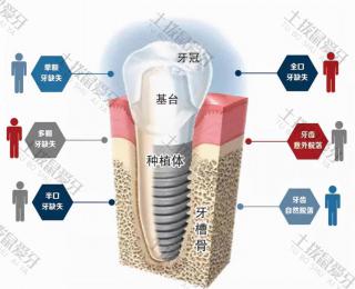 种植牙基台和牙冠怎么固定 半口种植牙戴牙冠全过程