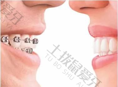 牙齿稀疏矫正方法