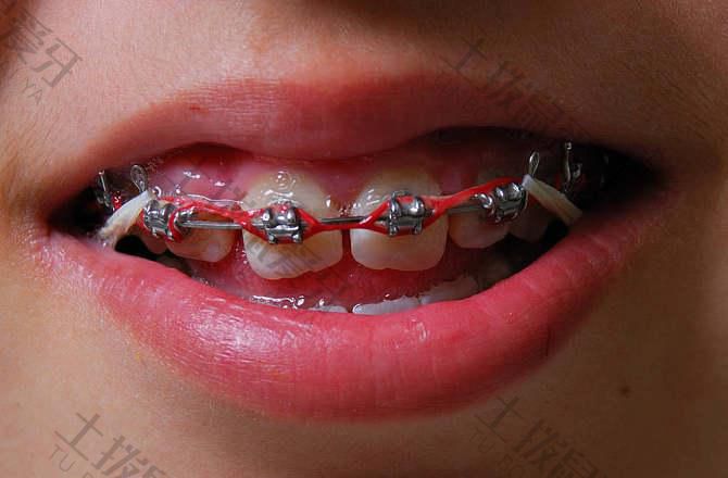 牙齿矫正牙齿出现黑三角是什原因