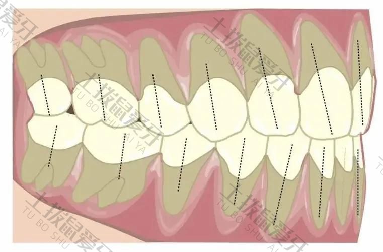 成年人的牙齿深覆合怎么矫正
