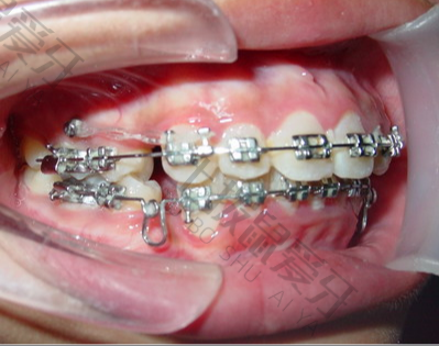 儿童早期牙齿矫正方法