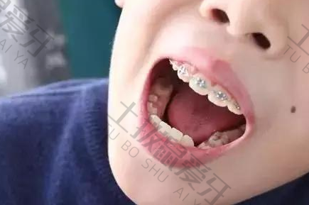 儿童早期牙齿矫正方法