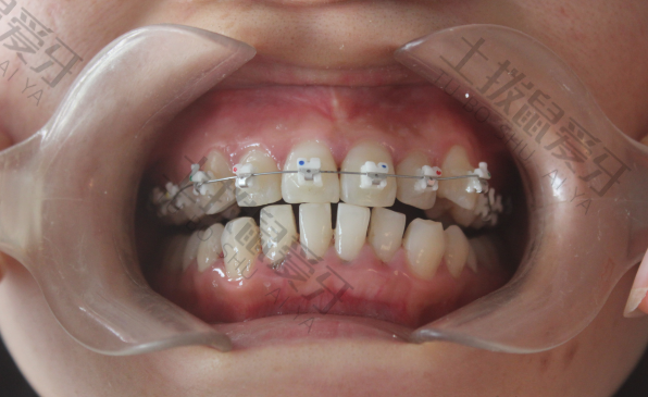 儿童早期牙齿矫正需要多长时间
