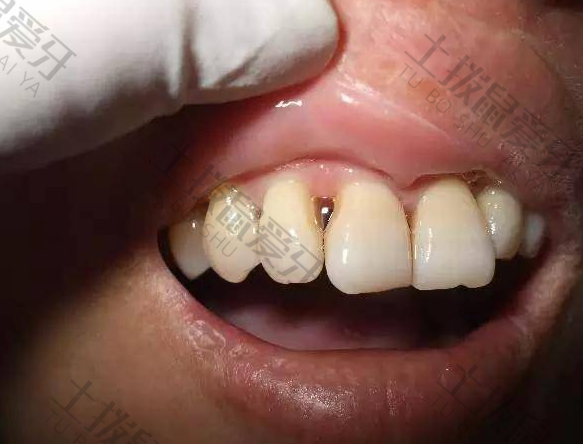 牙齿矫正后出现黑三角有什么影响吗