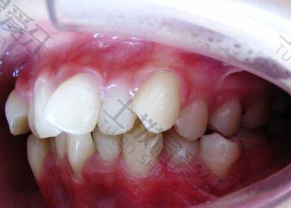 矫正牙齿牙龈增生怎么办