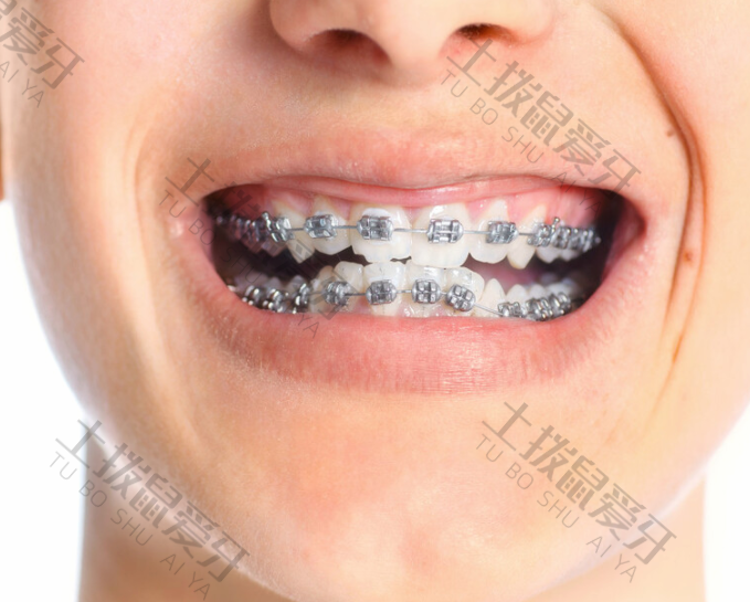 牙龈龅牙有办法矫正吗