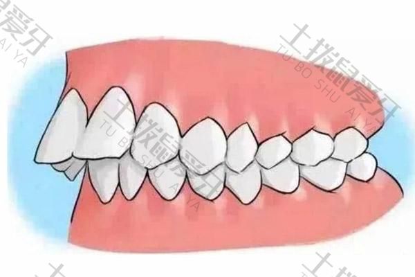 牙龈龅牙有办法矫正吗