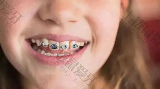 儿童牙齿地包天矫正器材质