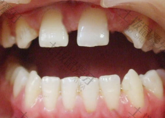 牙齿稀疏牙缝大带牙套能矫正过来吗