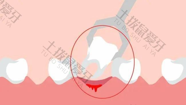 矫正牙齿拔牙好不好