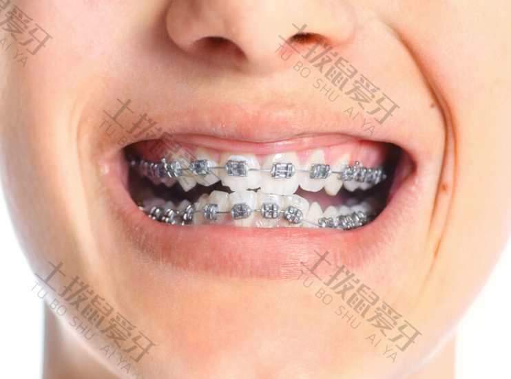 牙齿稀疏矫矫正牙齿过程