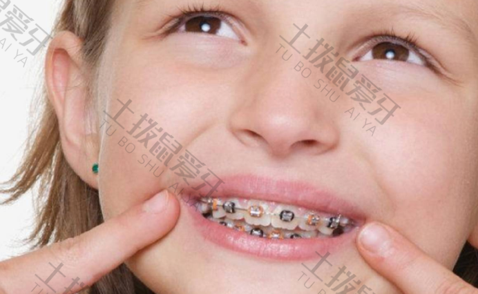 儿童牙齿早期矫正的好处