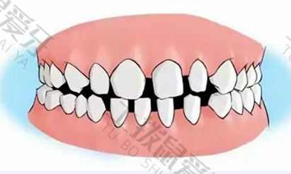 牙齿稀疏牙缝大矫正需要多长时间