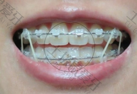 牙齿稀疏矫矫正牙齿过程