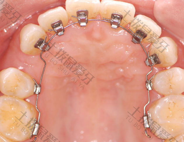 牙齿矫正牙龈萎缩的原因