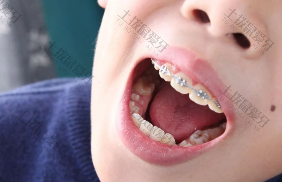 儿童早期矫正牙齿有什么好处