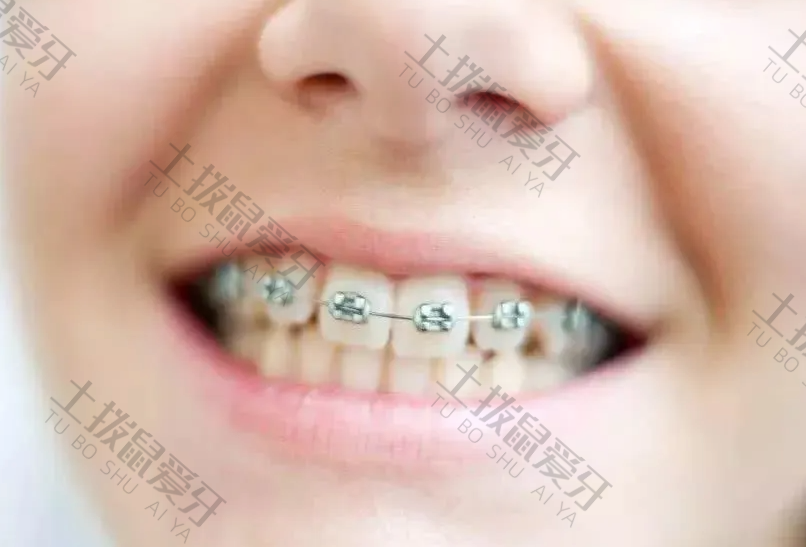 早期牙齿矫正方案