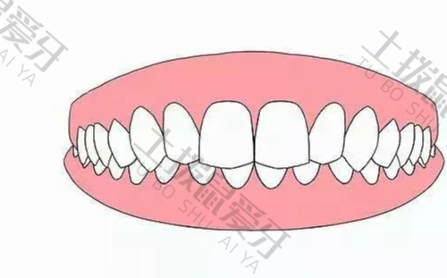 深覆合可以通过牙齿矫正改善吗