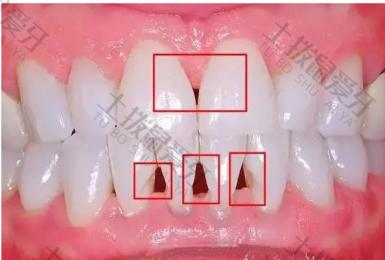 牙齿黑三角可以修复吗 矫正牙齿黑三角怎么处理