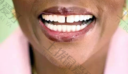 牙齿稀疏可以补牙吗