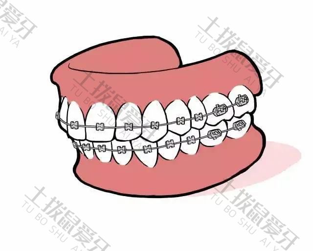 牙齿拥挤矫正费用多少钱
