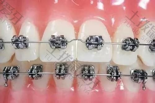 牙齿拥挤不拔牙可以矫正吗