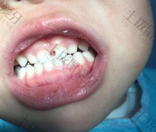 矫正牙齿牙龈突出什么原因