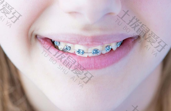 儿童牙齿早期干预矫正有几种 