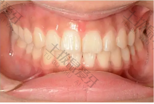 牙龈萎缩能矫正牙齿吗