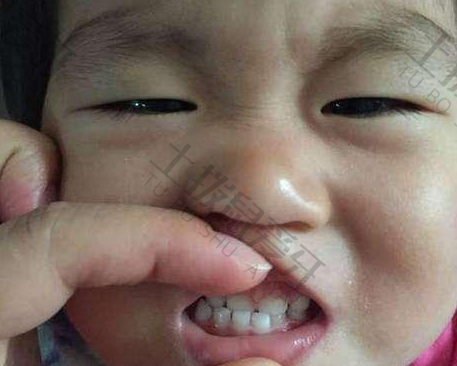 幼儿牙齿地包天如何矫正