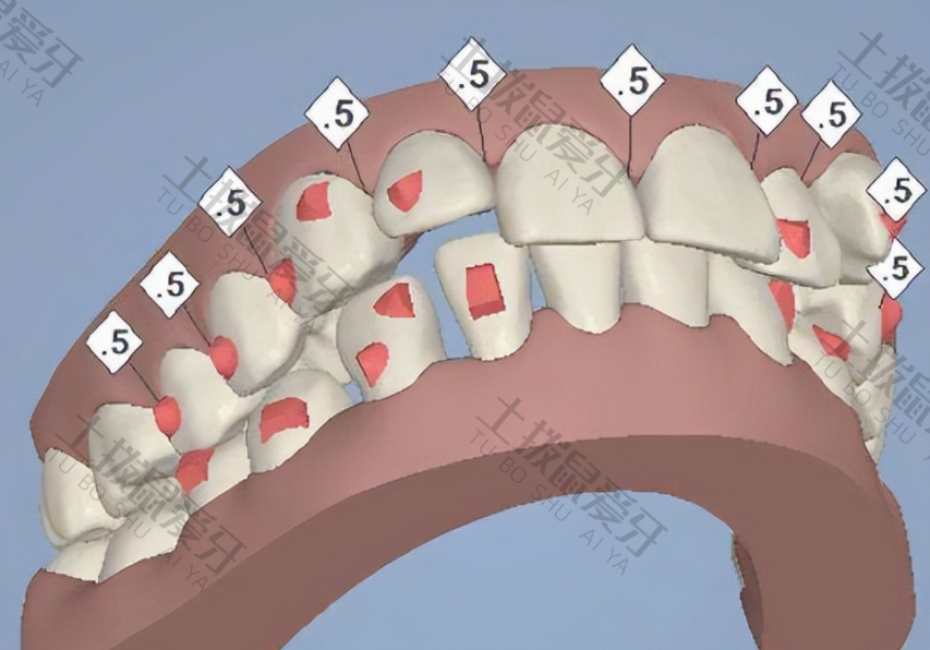 牙齿矫正有几种方式