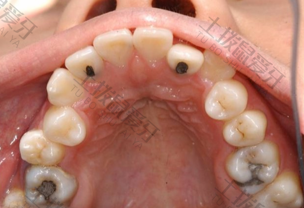 牙齿稀疏可以做牙齿矫正吗