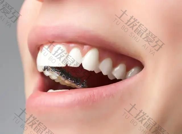 牙齿深覆合成人能矫正吗