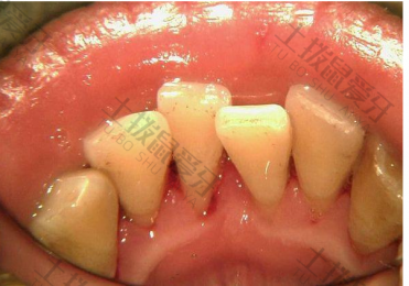 地包天牙齿矫正过程 牙齿矫正效果好吗