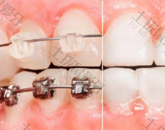 畸形牙齿矫正得多少钱 牙齿畸形矫正要拔牙吗