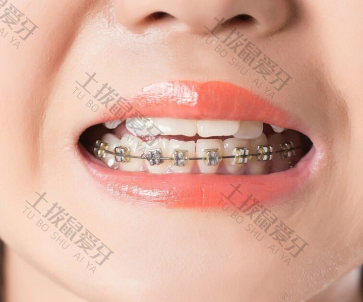 牙齿深覆合成年还有必要矫正吗