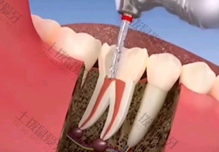 根管治疗后牙齿的寿命