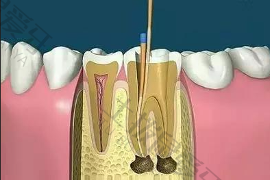 根管治疗很痛吗