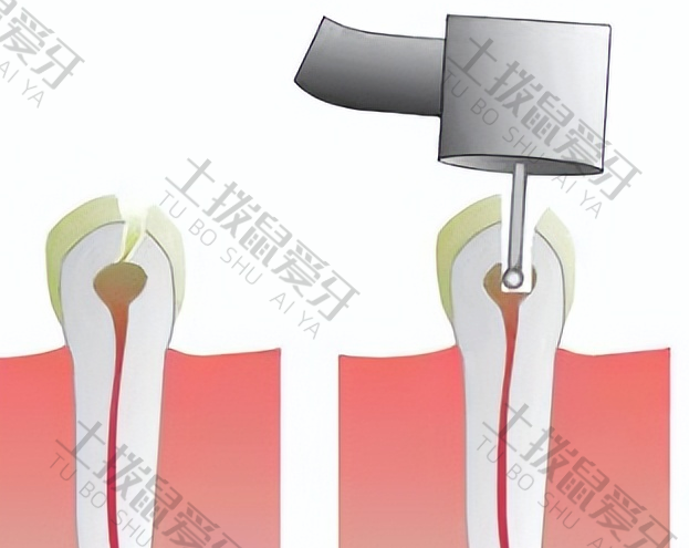 根管治疗的步骤过程