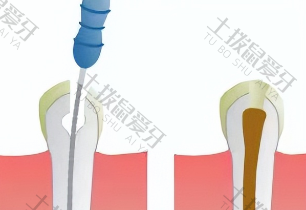根管治疗的步骤过程