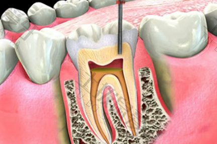 牙髓炎根管治疗后需要做牙套吗