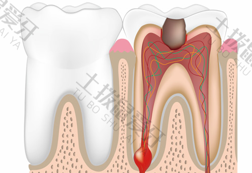 牙髓炎根管治疗需要多长时间