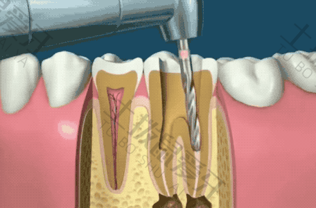 牙髓炎根管治疗后需要做牙套吗
