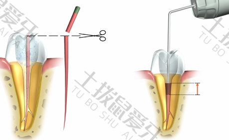 根管治疗有必要吗