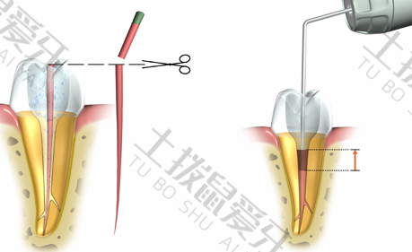 儿童补牙需要几次完成